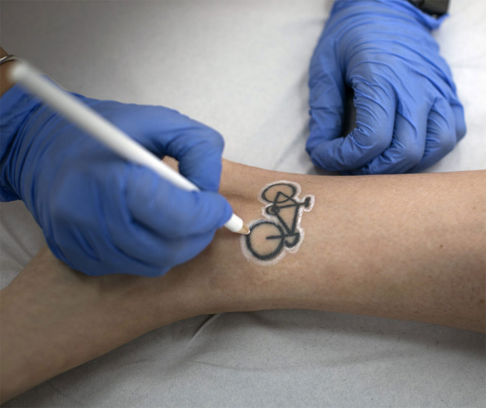 Infinity Láser persona retirando tatuaje