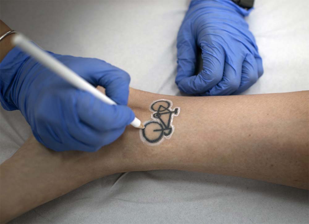 Infinity Láser persona eliminando tatuaje